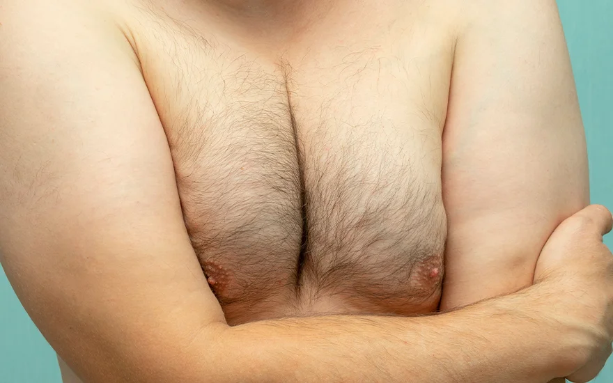 What is Male Gynecomastia?