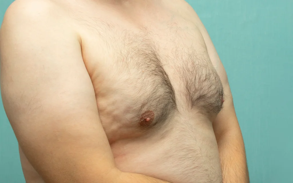 Male Gynecomastia